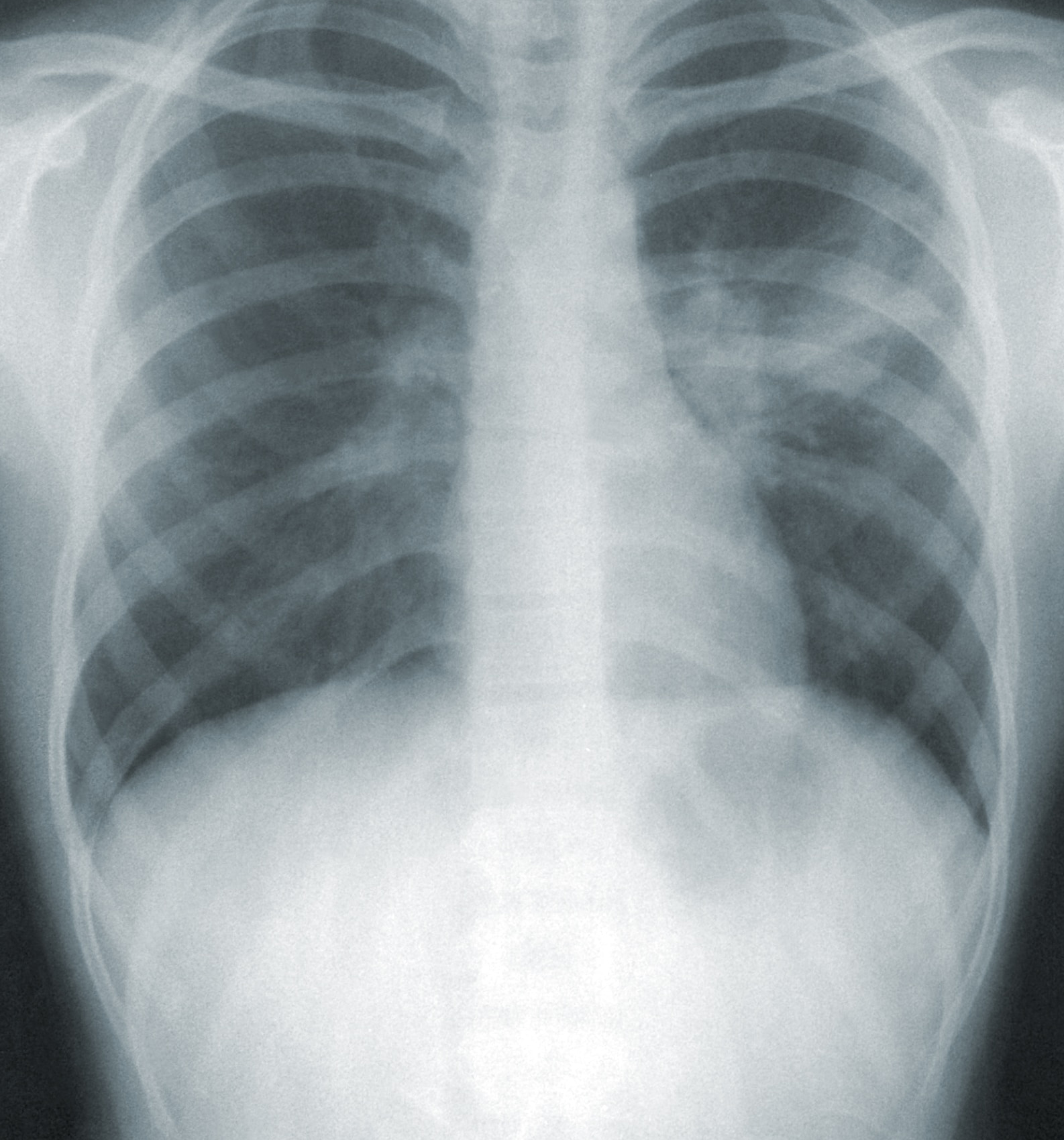 Chest X-Ray Image